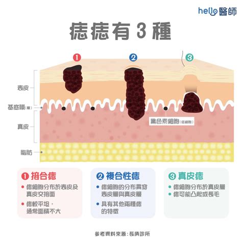 長痣的位置|痣形成的原因？痣長毛、痣變多變大是痣病變？5招判。